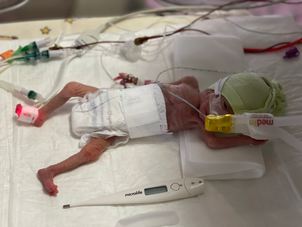Kolejny sukces rudzkich Neonatologów. Medycy ze Szpitala Miejskiego w Rudzie Śląskiej uratowali dziecko, które urodziło się zdecydowanie za wcześnie – w 26. tygodniu ciąży! Dzisiaj mała Martusia wyszła ze szpitala do domu!

fot. Szpital Miejski w Rudzie Śląskiej